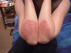 Hypnotherapy Psoriasis