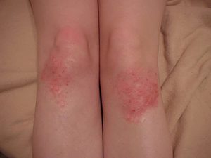 hypnotherapy psoriasis