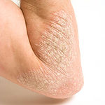 psoriasis