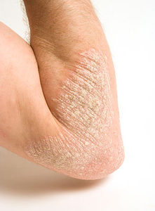 psoriasis-elbow-paid small hypnotherapy for psoriasis