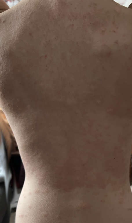 Christine psoriasis on back 1 week later