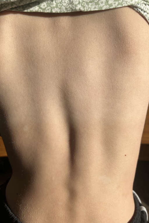 hypnotherapy for psoriasis