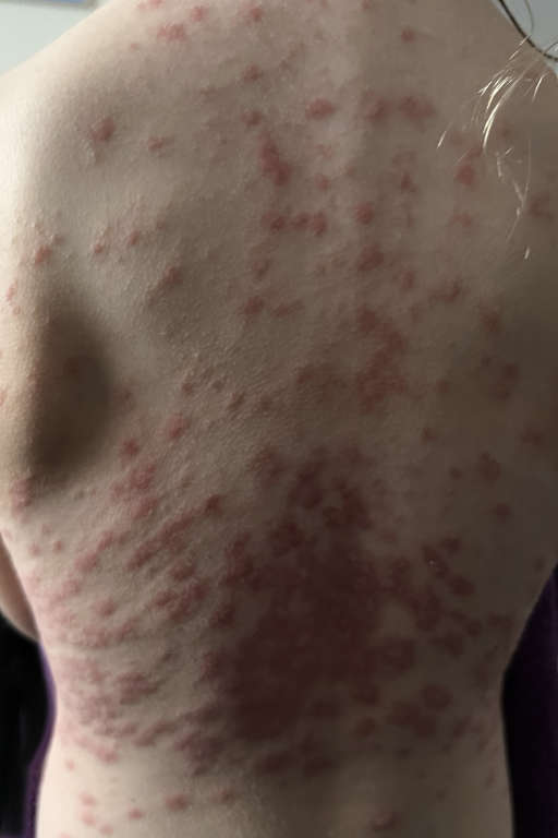 hypnotherapy for psoriasis