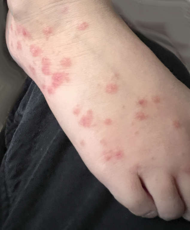 hypnotherapy for psoriasis