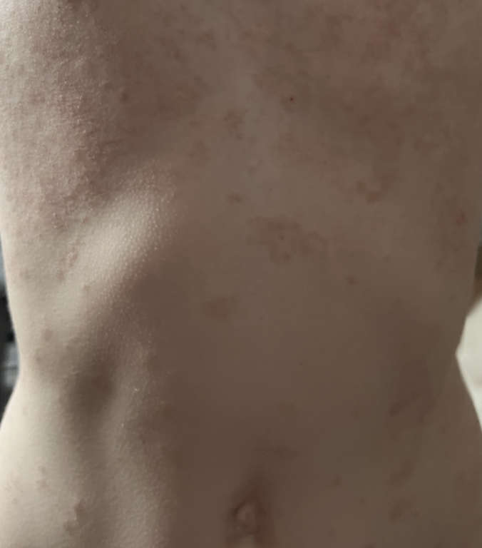 Christine psoriasis on  front 1 week later