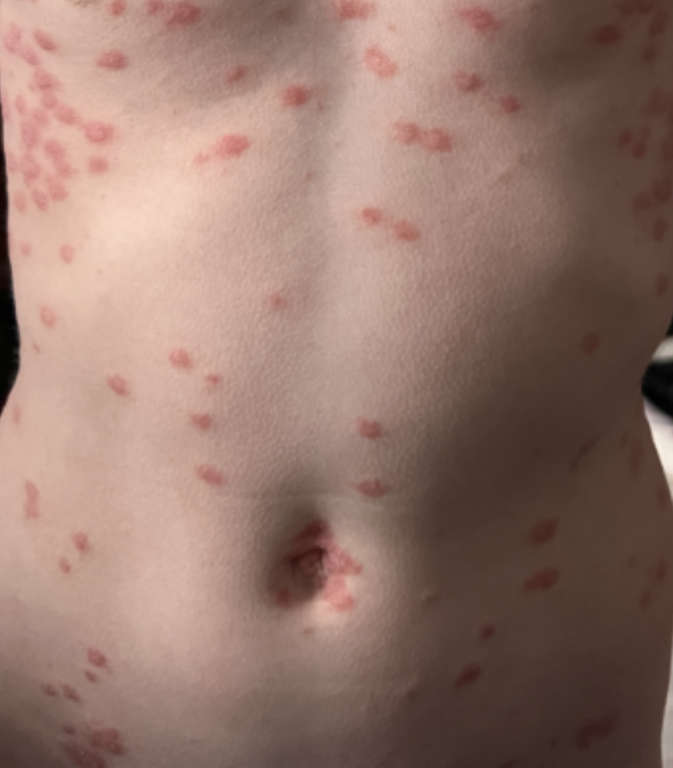 hypnotherapy for psoriasis