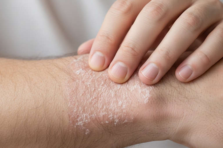 Person touching their dry skin