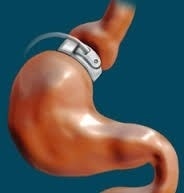 hypnotic gastric band