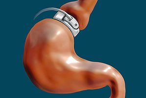 hypnotic gastric band