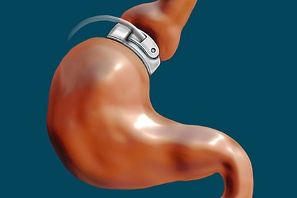 Hypnotic Gastric Band